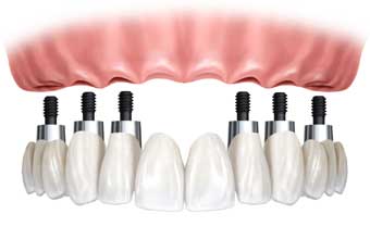 Mantuan Prótese Dental - Foto 1